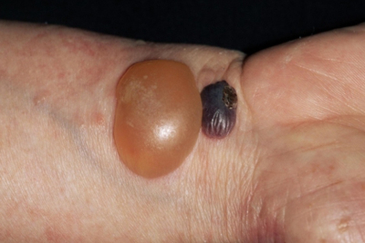 大疱性类天疱疮大水疱图 大疱性类天疱疮大水疱图