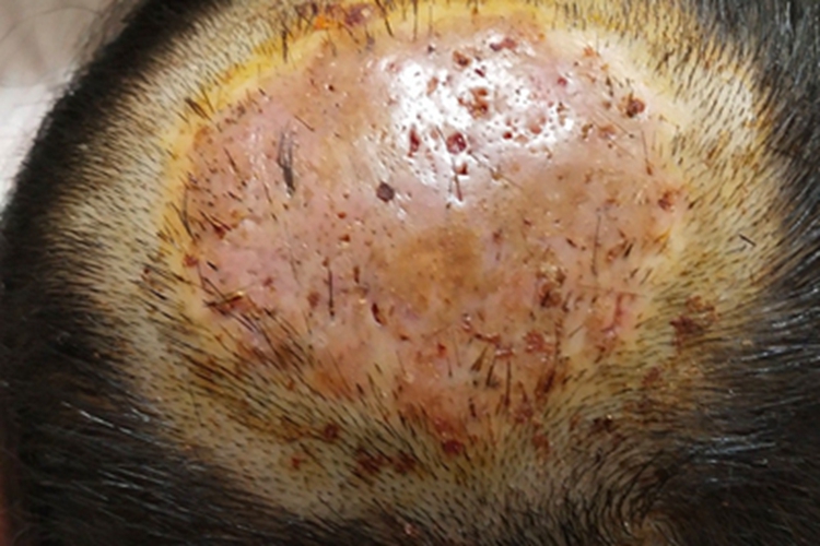 头癣头皮脱发图