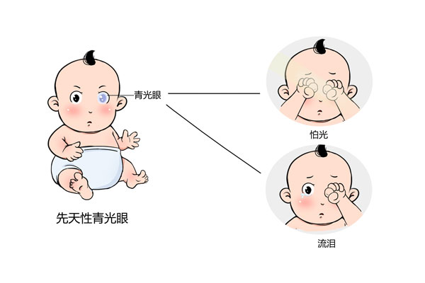 婴儿青光眼图片图片