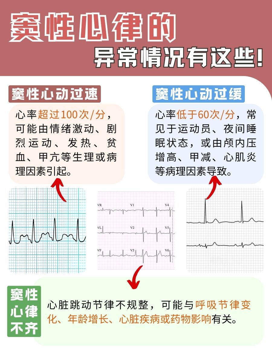 窦性心律科普：你心脏健康的“晴雨表”