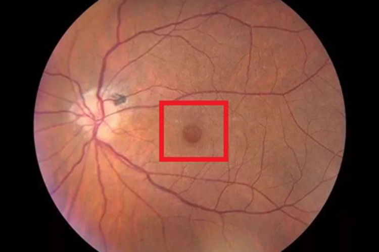 黄斑裂孔黄斑区有斑点图