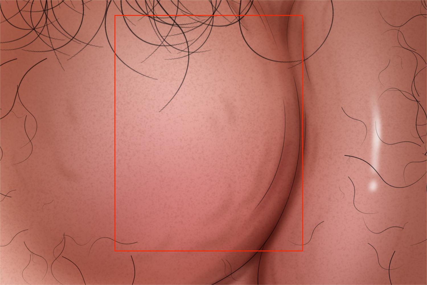 前庭大腺囊肿图