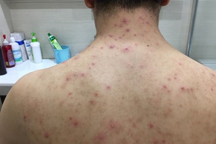 铜绿假单胞菌毛囊炎背部丘疹图