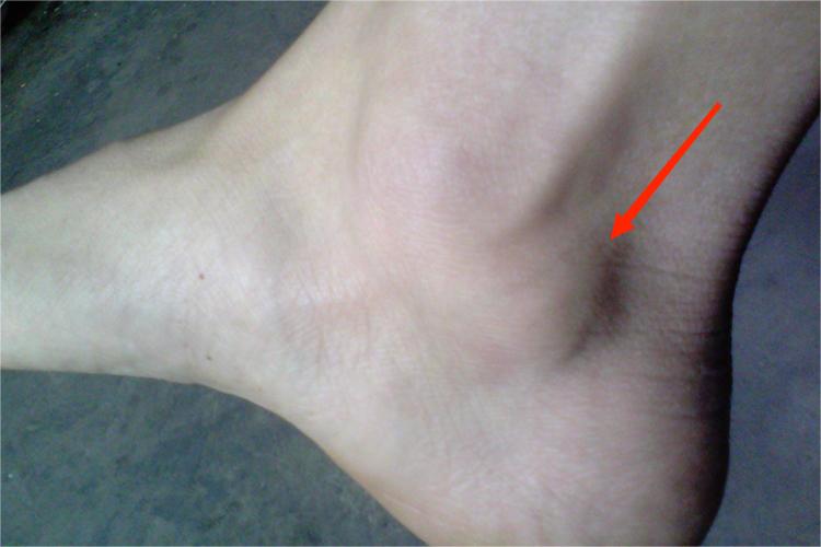 右脚踝处腱鞘囊肿肿块图