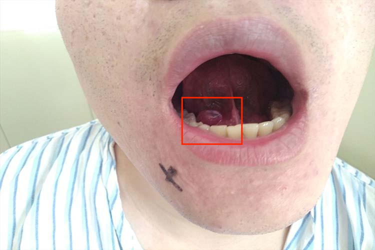 舌下腺囊肿舌下腺一侧肿大图