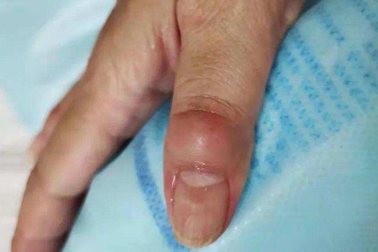 拇指黏液性囊肿图