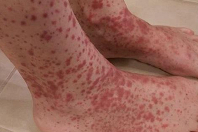过敏性紫癜脚背疙瘩图