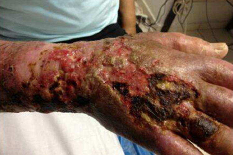 坏疽黑痂图 坏疽黑痂图