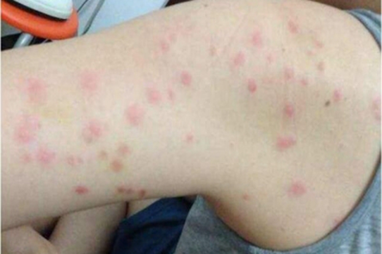 螨虫皮炎胳膊症状图