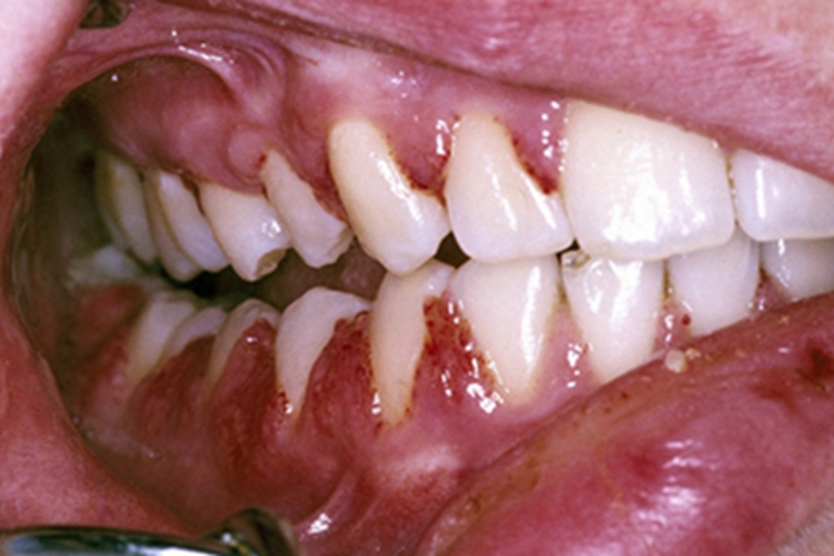 牙龈炎牙龈边缘充血图