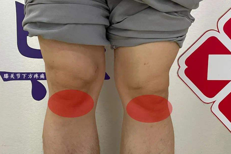 膝盖肌腱炎疼痛区图