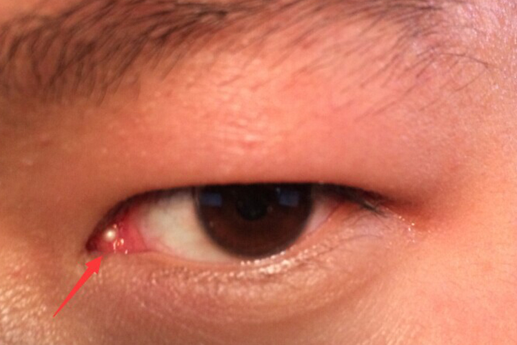 泪阜皮脂腺囊肿图
