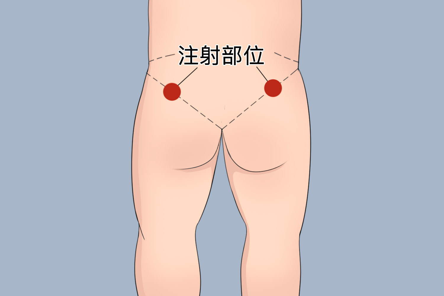 臀部肌肉注射部位图 臀部肌肉注射部位图