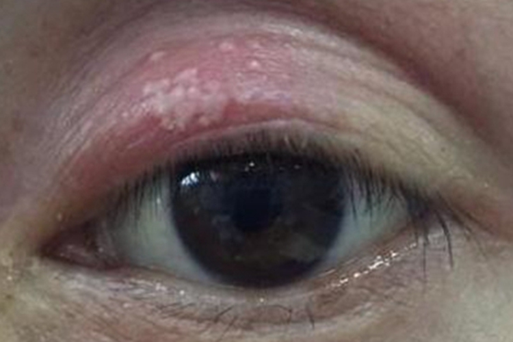 眼睑热性疱疹眼睑小疙瘩图