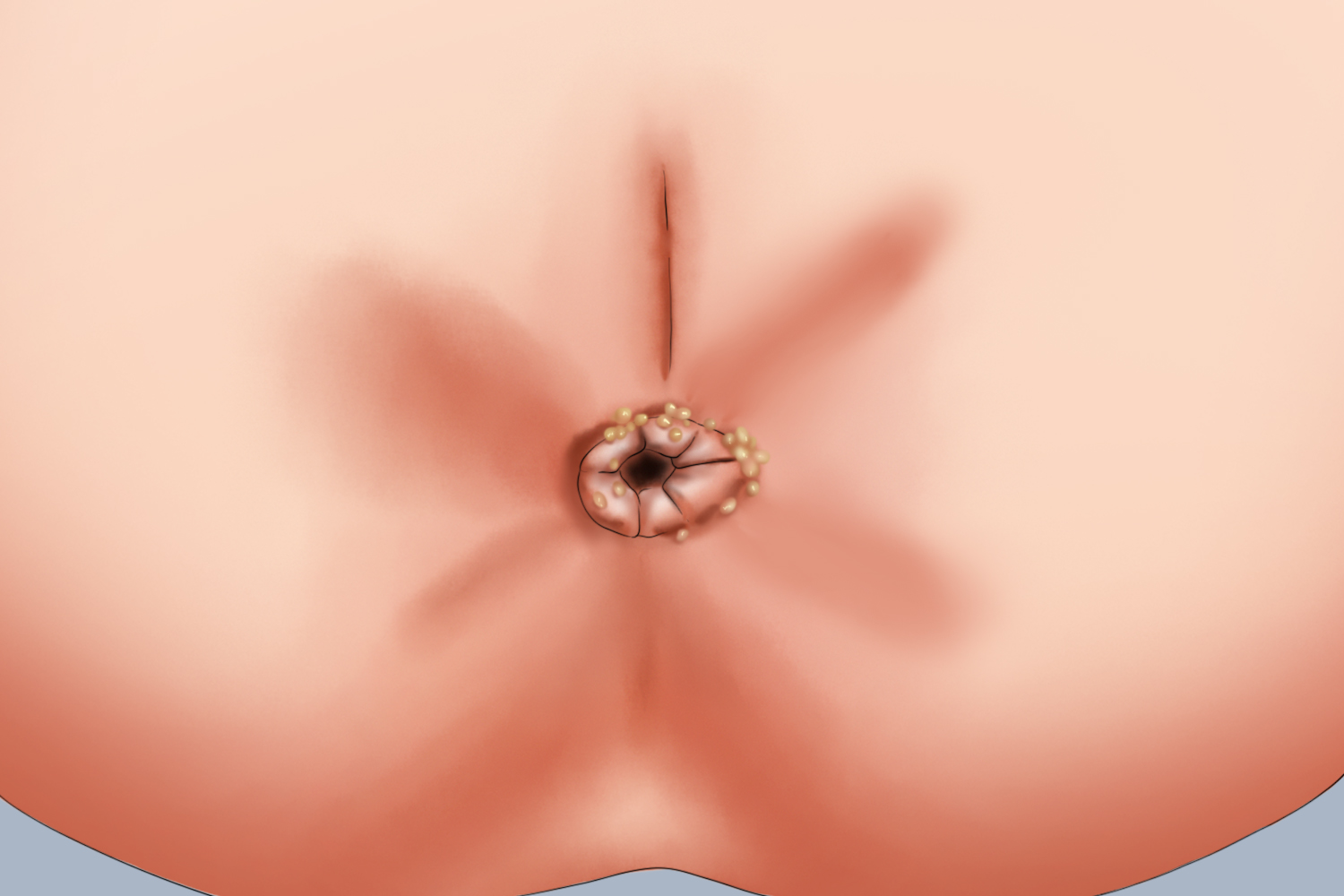 肛门疱疹图 肛门疱疹图