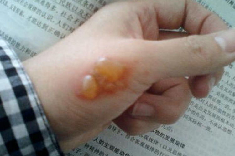 烟头浅Ⅱ度烫伤图