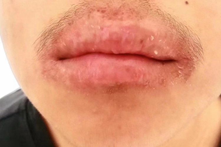 剥脱性唇炎红肿图