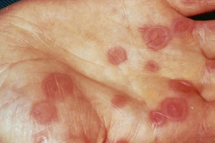 牛痘样水疱病典型轻型红斑图