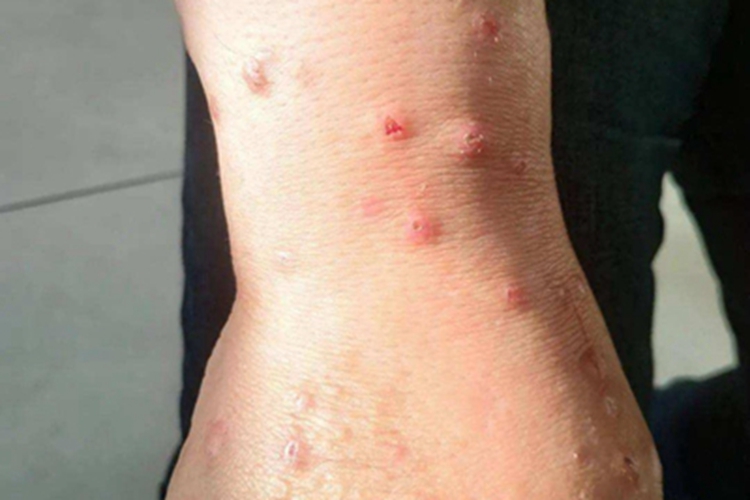 痒疹手腕疙瘩图