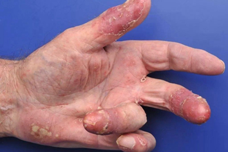 脓疱性肢端皮炎手指脱皮图