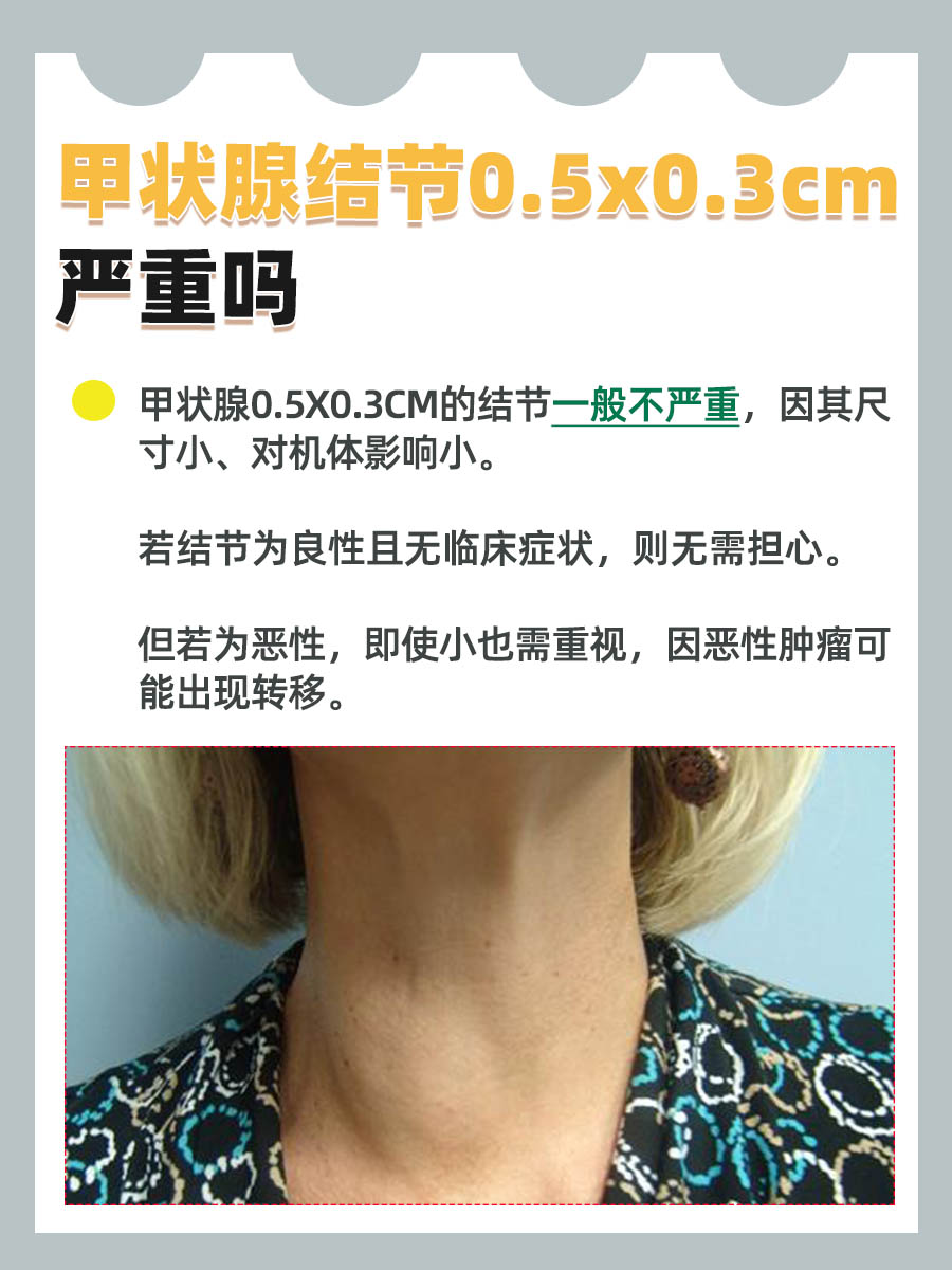 带你了解:甲状腺结节0.5x0.3cm严重吗?