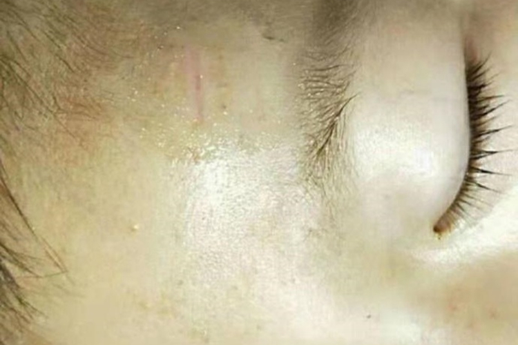 孩子额头缝针疤痕恢复图