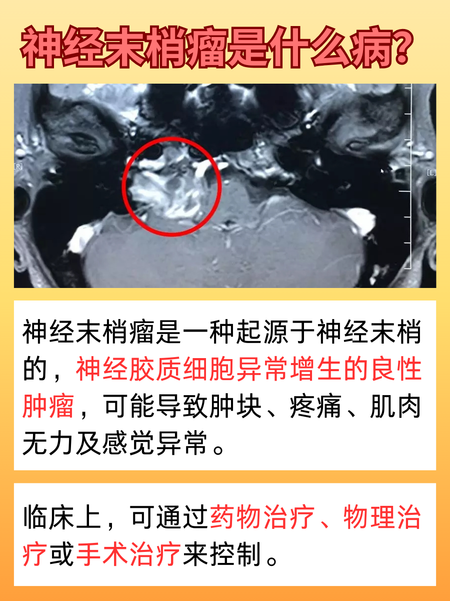 神经末梢瘤听说过吗?这是什么病?
