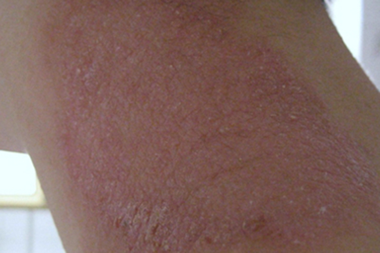 神经性皮炎颈部皮肤粗糙图