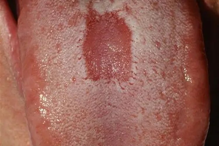 男性梅毒舌头水肿图