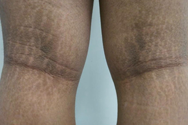 黑棘皮病腘窝症状图 黑棘皮病腘窝症状图