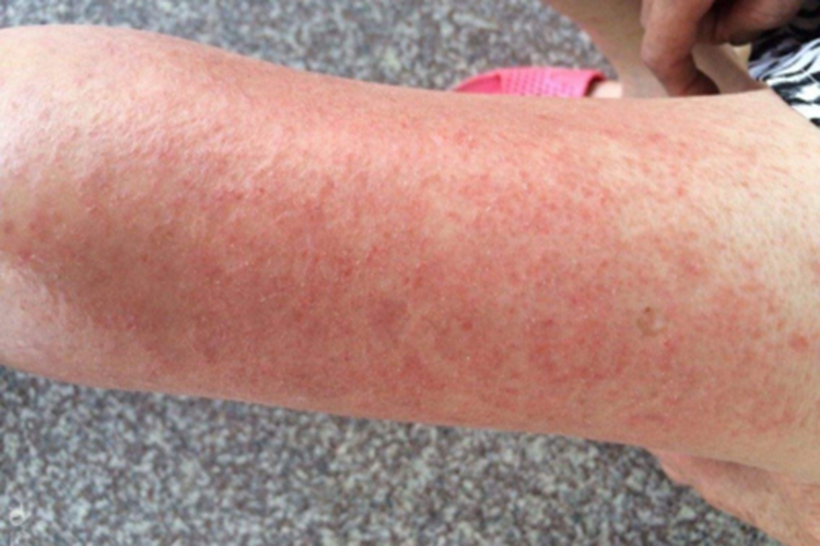 刺激性接触性皮炎大腿丘疹图 刺激性接触性皮炎大腿丘疹图