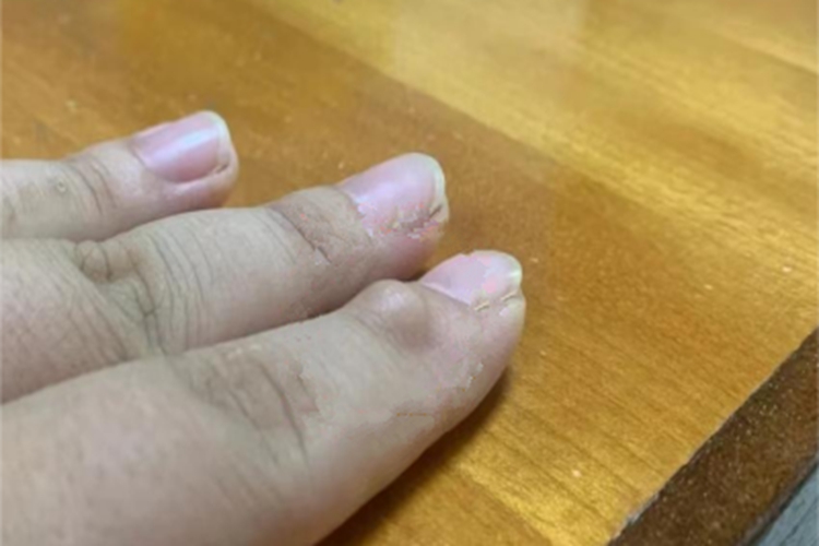 成人型纤维肉瘤手指症状图 成人型纤维肉瘤手指症状图