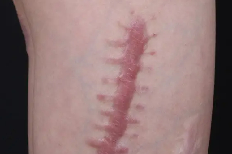 纤维瘤切除后疤痕增生图