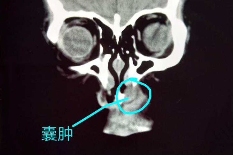 鼻前庭囊肿影像图