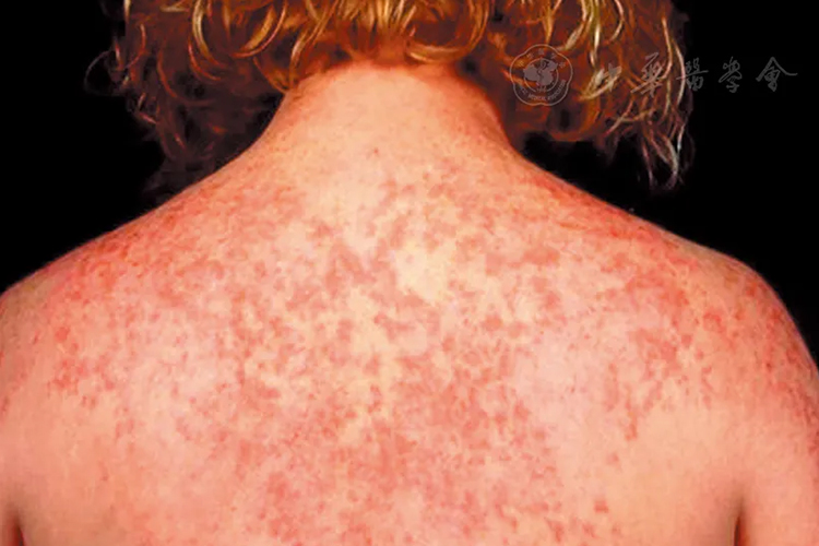 系统性红斑狼疮小红点图