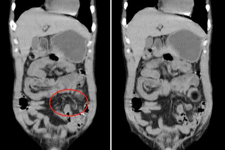 小肠脂肪瘤并肠套叠CT图