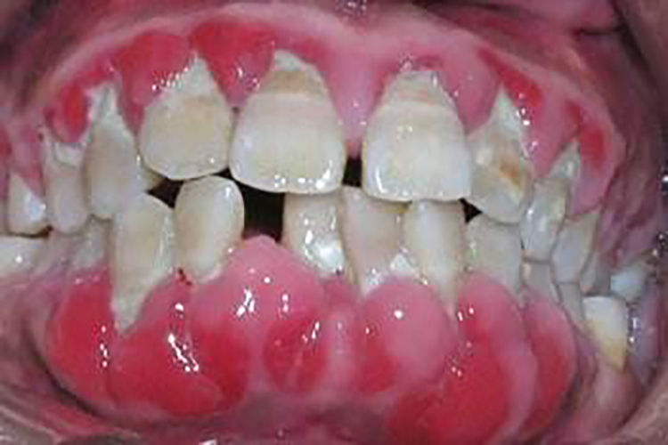 牙周炎治疗前图