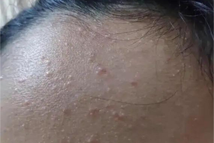 痤疮额头上长了好多小疹子图