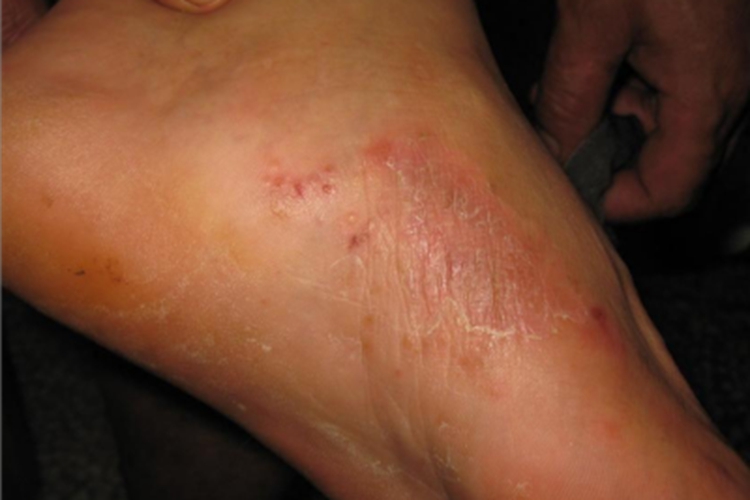 湿疹样型癣菌疹脚部红斑图