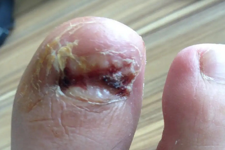 拔甲后肉芽组织图