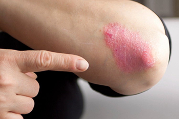 慢性苔藓样角化病肘部症状图