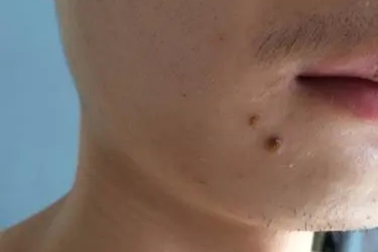 男士药物点痣图