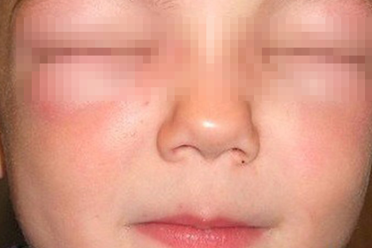 荨麻疹面部肿胀图