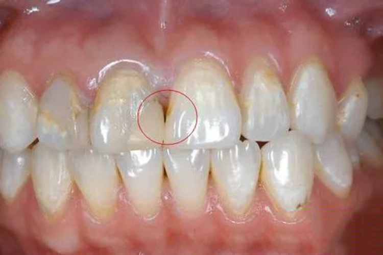 门牙邻面龋浅龋图