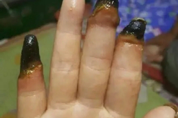 湿性坏疽手指症状图