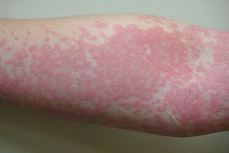 中毒型猩红热皮疹图