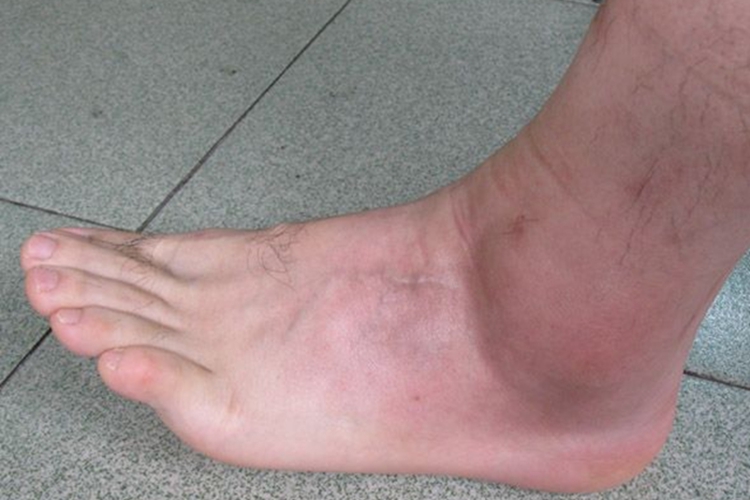 男人踝关节扭伤脚肿图 男人踝关节扭伤脚肿图