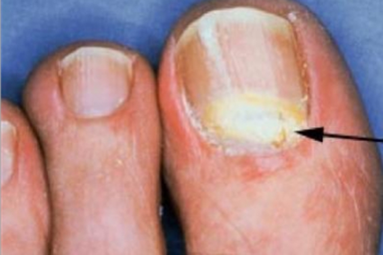 甲床炎大拇脚趾发白图