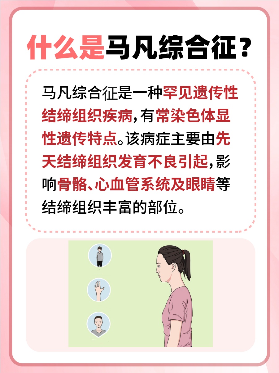 深度揭秘：马凡综合征是什么？