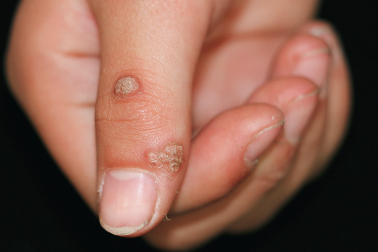 疣状物是什么样子图片